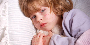 Approach to Child with Rash II