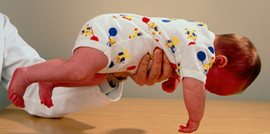 Approach to Hypotonia