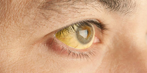 Approach to Jaundice