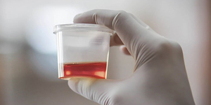 Approach to Red Urine