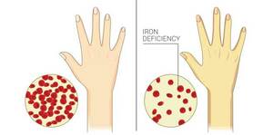 Iron Deficiency