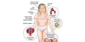 Turner Syndrome