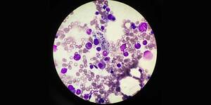 Macrophage activation syndrome, a preventable cause of mortality in general practice