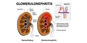 Glomerular disease