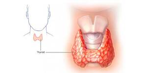 Updated Guidelines in Treating Hyperthyroidism