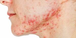 Acne vulgaris