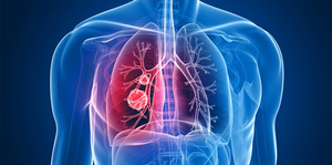 Evidence-Based Medicine in Management of Complicated Pneumonia in Children