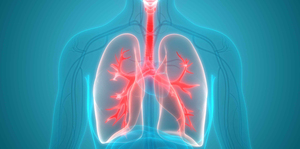 what is Acute Respiratory Distress Syndrome