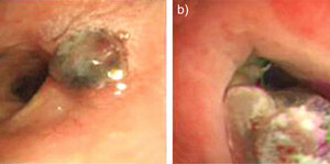 TB Paradoxical Reactions; Commonly Unrecognized Disease