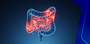 Crohn’s Disease