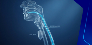 Risk of aspiration and dysphagia management