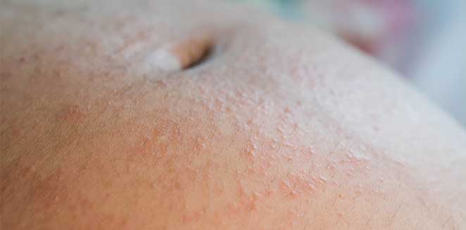Approach to Pregnant Dermatoses