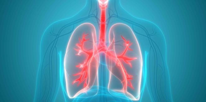 what is Acute Respiratory Distress Syndrome