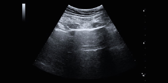 Ultrasound Lung in COVID-19 Patients